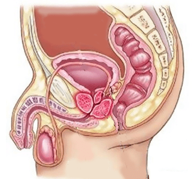Causas de cistitis en hombres