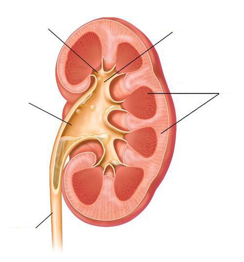 Pielonefritis aguda como complicación de la cistitis.