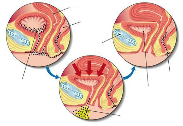 bacterias en la vejiga con cistitis