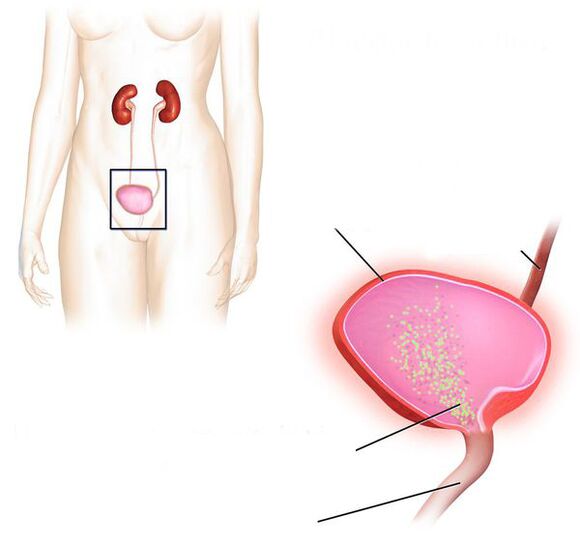 inflamación de la vejiga